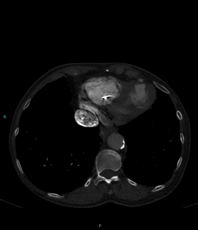 Calcified cerebral emboli from left ventricular thrombus (Radiopaedia 84420-99760 Axial bone window 68).jpg