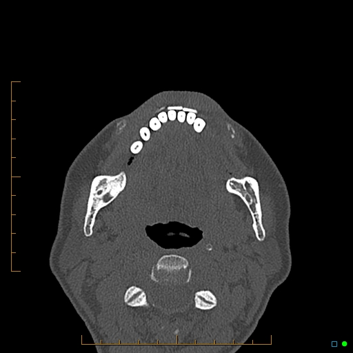 Calcified facial augmentation fillers (Radiopaedia 79514-92679 Axial bone window 122).jpg