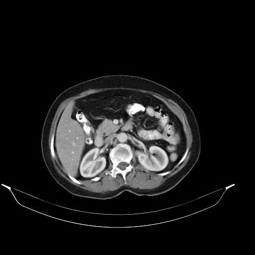 File:Calcified hydatid cyst of the liver (Radiopaedia 21212-21112 A 15).jpg