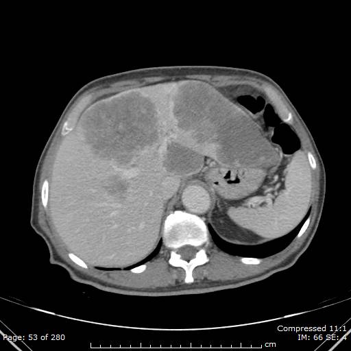 Calcified liver metastases (Radiopaedia 44699-48470 B 19).jpg