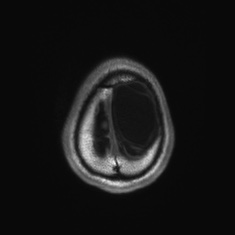 Callosal dysgenesis with interhemispheric cyst (Radiopaedia 53355-59335 Axial T1 147).jpg