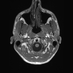 Callosal dysgenesis with interhemispheric cyst (Radiopaedia 53355-59335 Axial T1 8).jpg