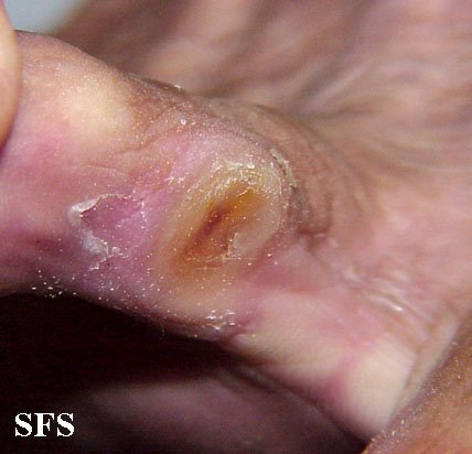 File:Callus (Dermatology Atlas 2).jpg