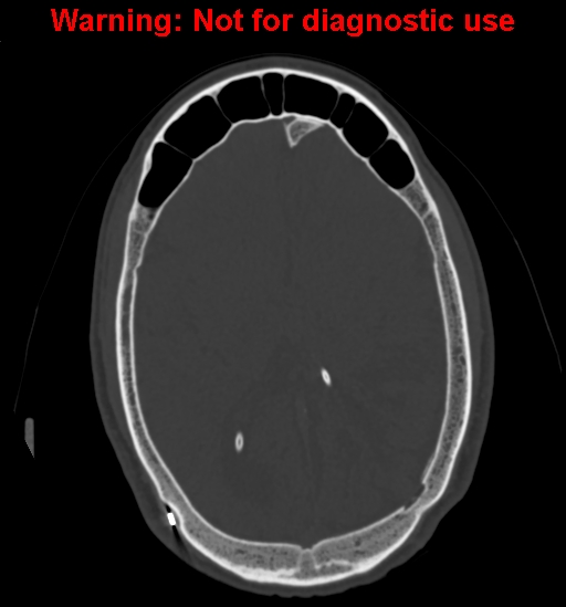 File:Calvarial thickening from chronic shunting (Radiopaedia 60079-67637 Axial bone window 105).jpg
