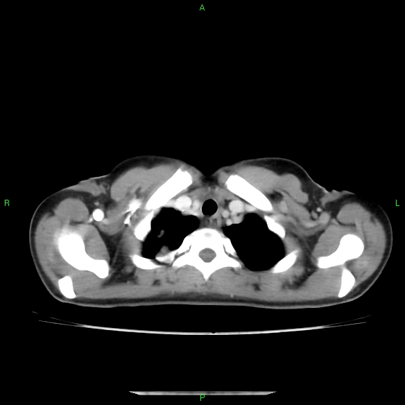 File:Cannon ball metastases - synovial sarcoma (Radiopaedia 26135-26271 C 5).jpg