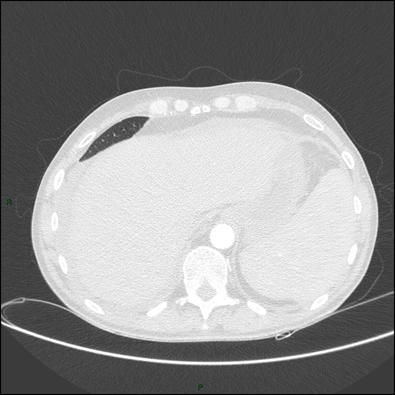 Cannonball metastases (Radiopaedia 82110-96150 Axial lung window 166).jpg