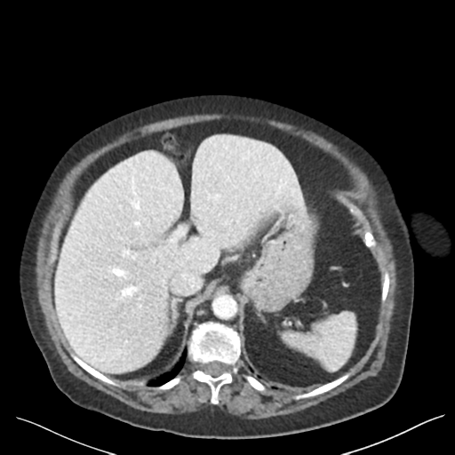 Cannonball metastases from endometrial cancer (Radiopaedia 42003-45031 E 22).png