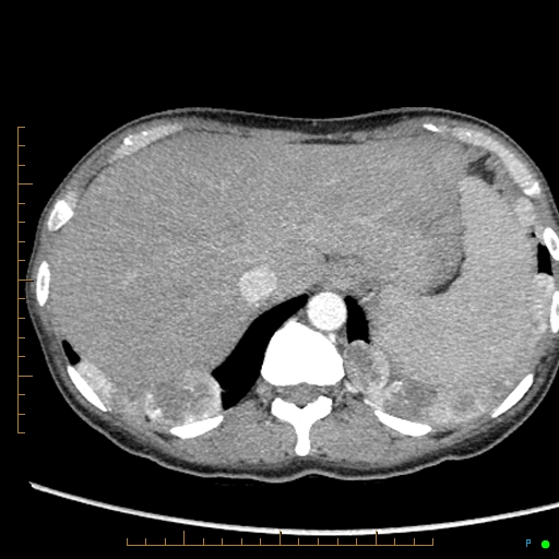 Canonball lung metastasis (Radiopaedia 77634-89837 B 92).jpg