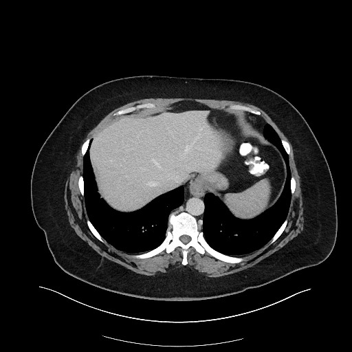 Carcinoid tumor - terminal ileum (Radiopaedia 60931-68739 A 19).jpg