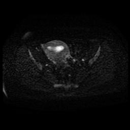 Carcinoma of the cervix (Radiopaedia 89018-105858 Axial DWI 37).jpg