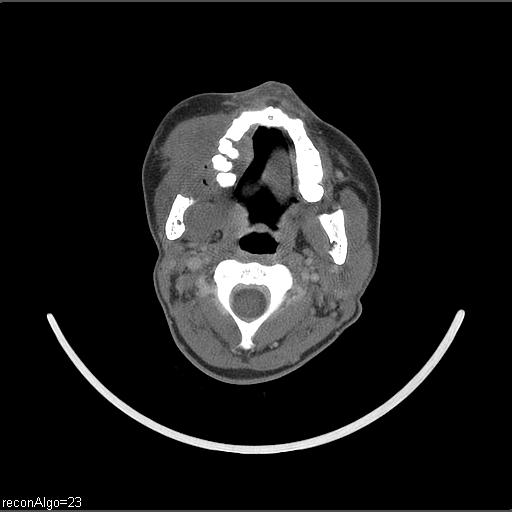 Carcinoma of the maxillary antrum (Radiopaedia 53805-59888 Axial C+ delayed 42).jpg