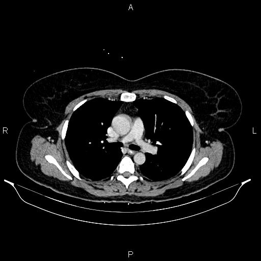 Carcinoma of uterine cervix (Radiopaedia 85861-101700 A 17).jpg