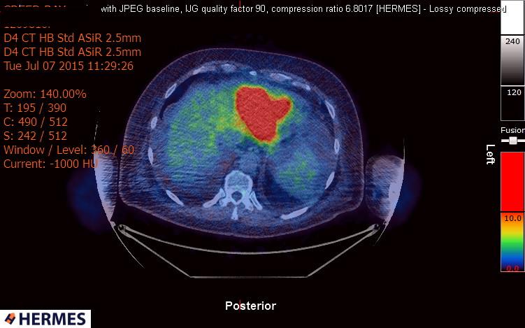 File:Cardiac lymphoma (Radiopaedia 38690-40871 Integrated PET-CT 19).jpg