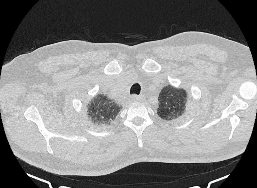 Cardiogenic pulmonary edema (Radiopaedia 68180-77678 Axial lung window 5).jpg