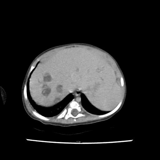 Caroli disease with autosomal recessive polycystic kidney disease (ARPKD) (Radiopaedia 89651-106703 B 27).jpg