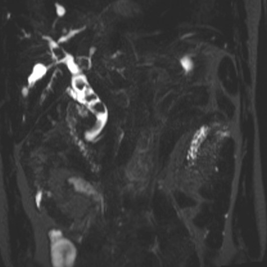 File:Caroli disease with medullary sponge kidney and nephrocalcinosis (Radiopaedia 10805-11251 Coronal T2 fat sat 1).jpg