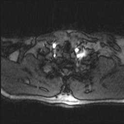 Carotid artery dissection (Radiopaedia 28441-28689 Axial MRA 11).jpg