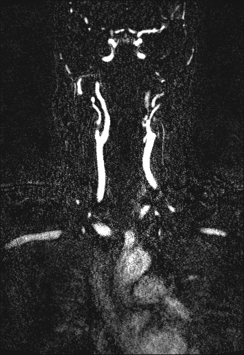 Carotid artery dissection (Radiopaedia 28441-28689 Coronal MRA 36).jpg