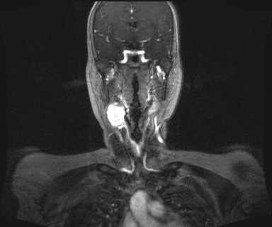 Carotid body tumor (Radiopaedia 12777-12912 MRA 25).jpg