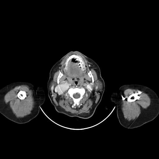 Carotid body tumor (Radiopaedia 21021-20948 A 14).jpg
