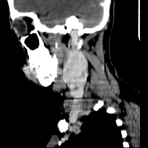 File:Carotid body tumor (Radiopaedia 27890-28124 C 19).jpg