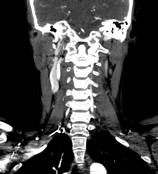 File:Carotid body tumor (Radiopaedia 39845-42300 C 61).jpg