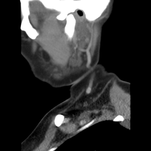 File:Carotid body tumor (paraganglioma) (Radiopaedia 38586-40729 C 7).jpg