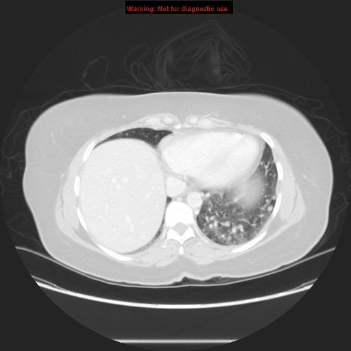 File:Carotid body tumor with lung metastases (Radiopaedia 9301-48390 Axial lung window 53).jpg