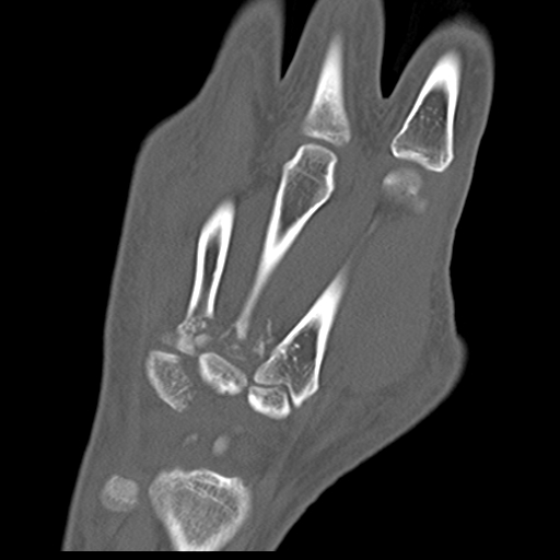 File:Carpo-metacarpal fracture-dislocations with hamatum split fracture (Radiopaedia 18482-18343 Coronal bone window 7).jpg