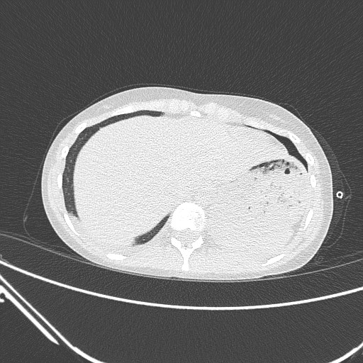 Catamenial pneumothorax (Radiopaedia 27946-28197 lung window 140).jpg