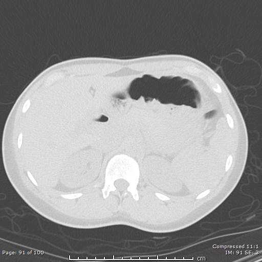 Catamenial pneumothorax (Radiopaedia 54382-60600 Axial non-contrast 91).jpg