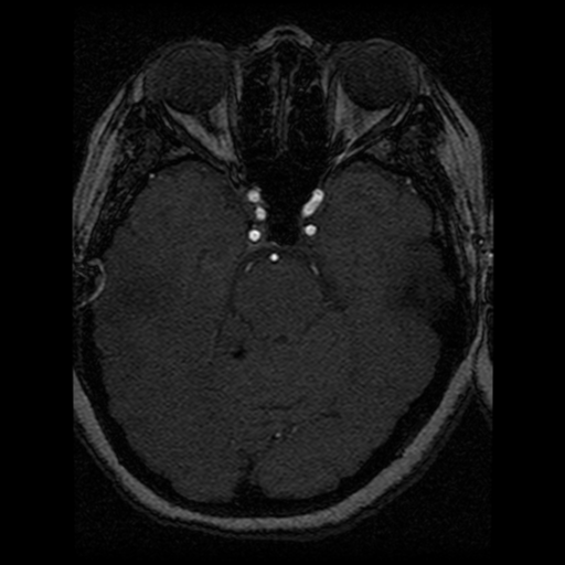 Cavernoma, DVA and right ICA aneurysm (Radiopaedia 33890-35072 E 62).png
