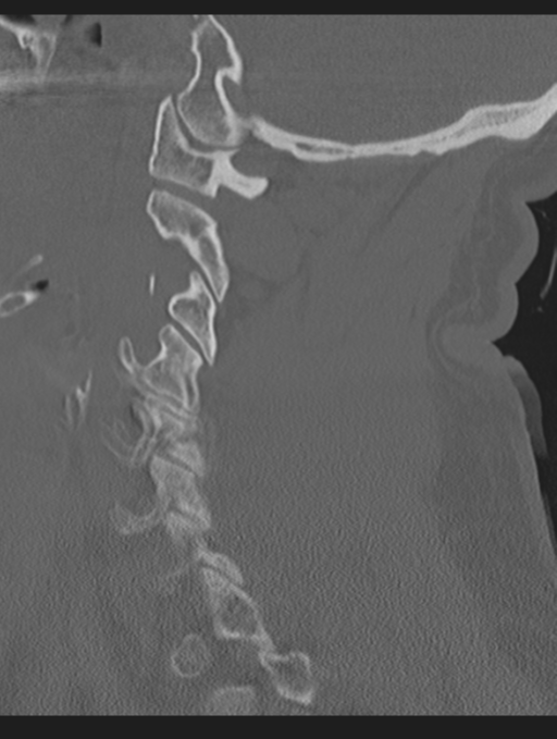 Cavernoma of cervical cord (Radiopaedia 50838-56346 Sagittal bone window 28).png