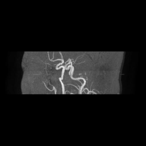 Cavernoma with developmental venous anomaly (Radiopaedia 22470-22507 MRA 4).jpg