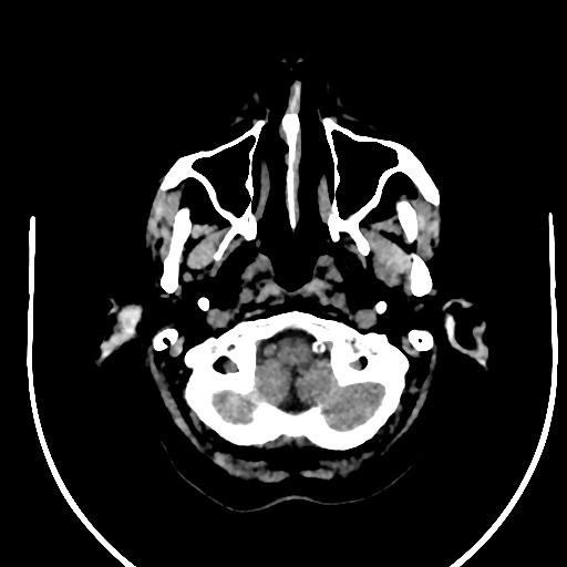 Cavernous hemangioma of the cerebellar falx (Radiopaedia 73025-83723 Axial non-contrast 10).jpg