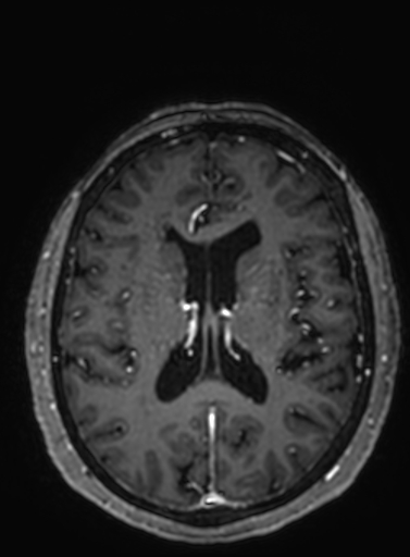 File:Cavernous hemangioma of the cerebellar falx (Radiopaedia 73025-83724 Axial T1 C+ 140).jpg