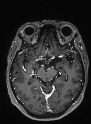 Cavernous hemangioma of the cerebellar falx (Radiopaedia 73025-83724 Axial T1 C+ 197).jpg