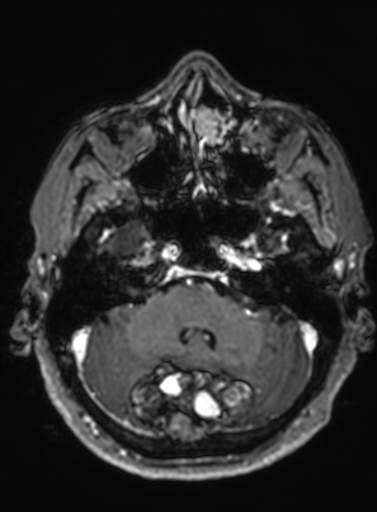 File:Cavernous hemangioma of the cerebellar falx (Radiopaedia 73025-83724 Axial T1 C+ 255).jpg