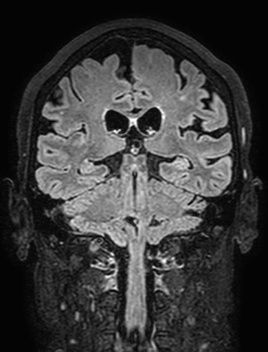 Cavernous hemangioma of the cerebellar falx (Radiopaedia 73025-83724 Coronal FLAIR 215).jpg
