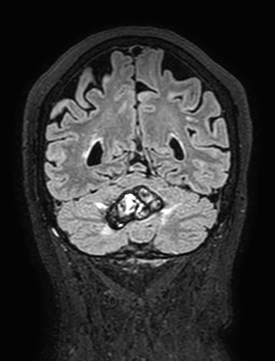 Cavernous hemangioma of the cerebellar falx (Radiopaedia 73025-83724 Coronal FLAIR 263).jpg