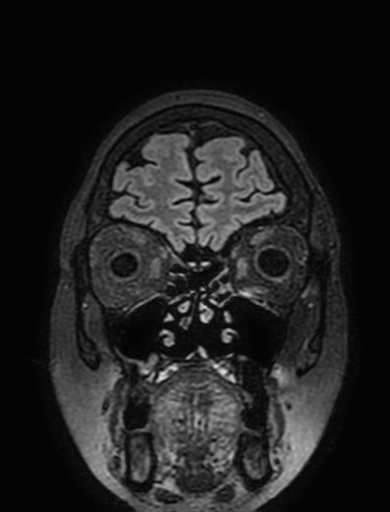 Cavernous hemangioma of the cerebellar falx (Radiopaedia 73025-83724 Coronal FLAIR 44).jpg