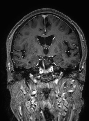 Cavernous hemangioma of the cerebellar falx (Radiopaedia 73025-83724 Coronal T1 C+ 180).jpg
