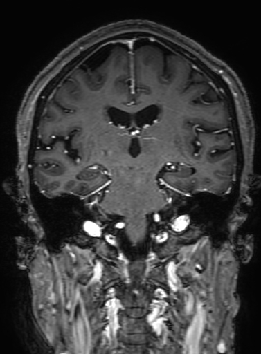Cavernous hemangioma of the cerebellar falx (Radiopaedia 73025-83724 Coronal T1 C+ 210).jpg