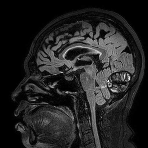 File:Cavernous hemangioma of the cerebellar falx (Radiopaedia 73025-83724 Sagittal FLAIR 112).jpg