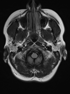 File:Cavernous malformation (cavernous angioma or cavernoma) (Radiopaedia 36675-38237 Axial T2 FLAIR 1).png