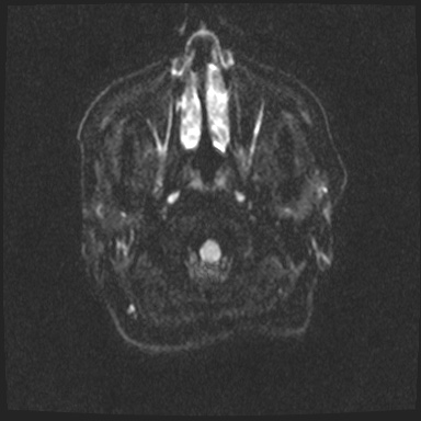 Cavernous sinus meningioma (Radiopaedia 63682-72367 DWI 22).jpg