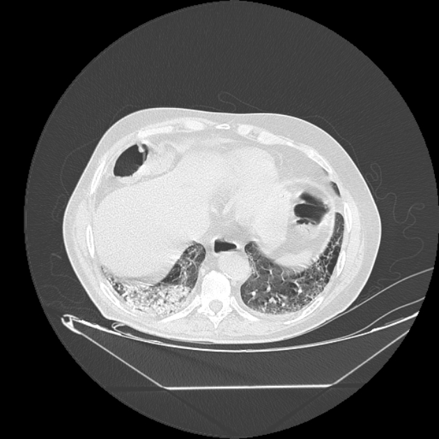 Cavitating bronchogenic carcinoma (Radiopaedia 44489-48162 Axial lung window 67).jpg