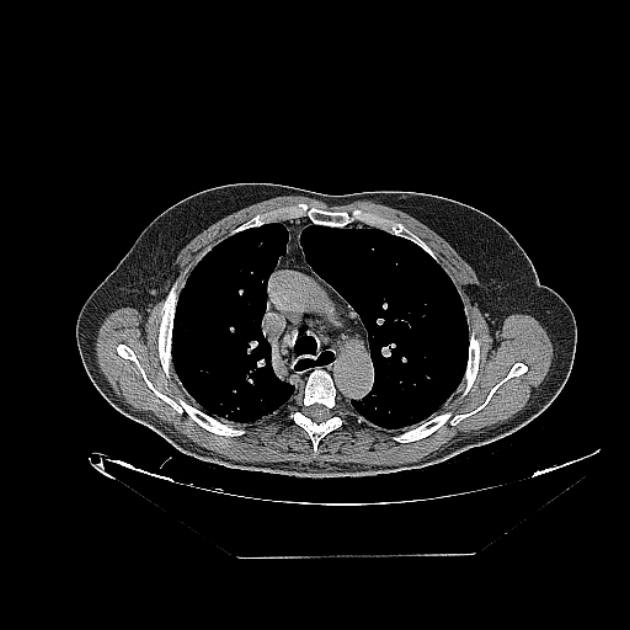 Cavitating bronchogenic carcinoma (Radiopaedia 44489-48162 Axial non-contrast 28).jpg