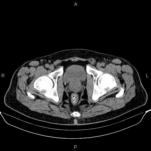 Cecal adenocarcinoma (Radiopaedia 85324-100916 Axial non-contrast 97).jpg