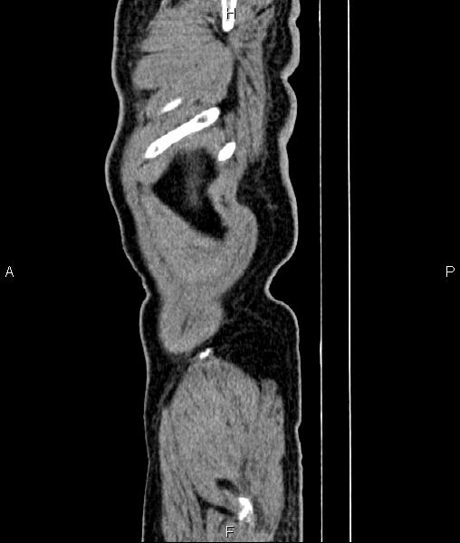 File:Cecal cancer with appendiceal mucocele (Radiopaedia 91080-108651 E 3).jpg